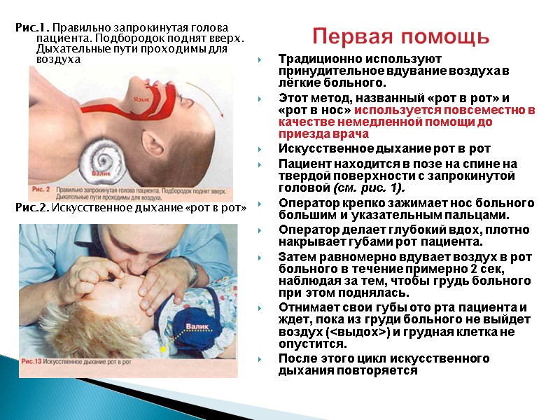 Первая помощь   Рис.1. Правильно запрокинутая голова пациента. Подбородок поднят вверх. Дыхательные пути